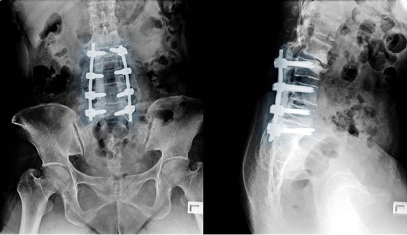 Bioactive Glass Implant